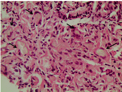 Figure 1 | Histological findings in the stomach of the case patient. Haematoxylin and eosin (H&E) staining. Magnification x400.