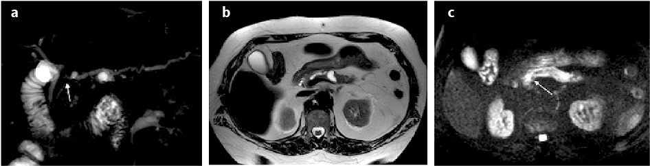 Mistakes in Pancreatobiliary Imaging Fig 7