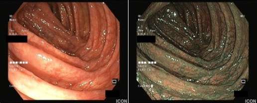 Figure 1 | Images of the ascending colon and of the area near the hepatic flexure during withdrawal of the colonoscope under conventional white-light and narrow-band imaging conditions.