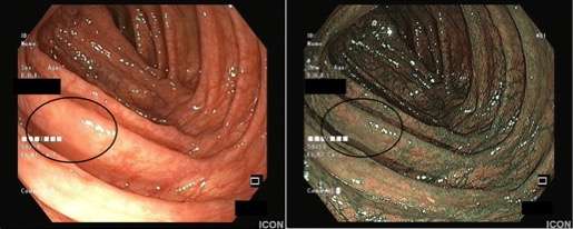 elusive lesion in the colon