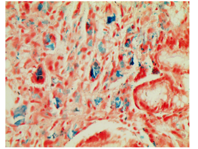 Figure 3 | Iron crystalline material stained blue. Perls’ histochemical stain (also known as Prussian blue). Magnification x400.