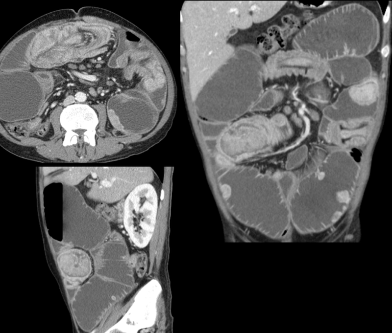 Figure 2 | Abdominal contrast-enhanced CT scan with coronal and sagittal reconstructions; images were acquired at portal venous time (about 70 seconds after injection of iodinated contrast medium).