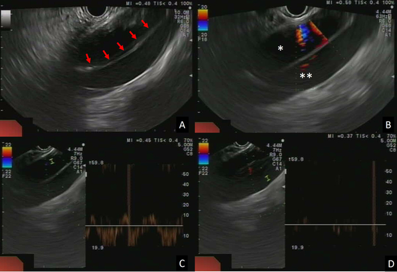 Figure 1 | EUS view of the aortic dissection. A | B-mode image showing the dissected thoracic aorta with the intimal flap (arrows) separating the two lumens. B | Colour Doppler showing blood flow in the true lumen (*) and no flow in the false lumen (**).