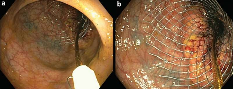 Colonic stent placement