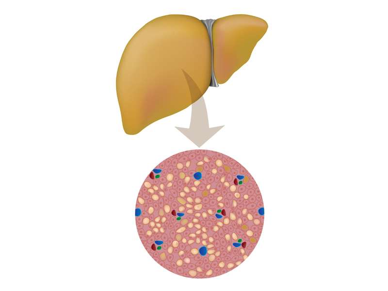 Mistakes in nonalcoholic fatty liver disease